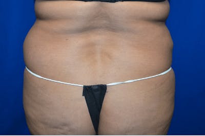 Liposuction Before & After Gallery - Patient 154000 - Image 1