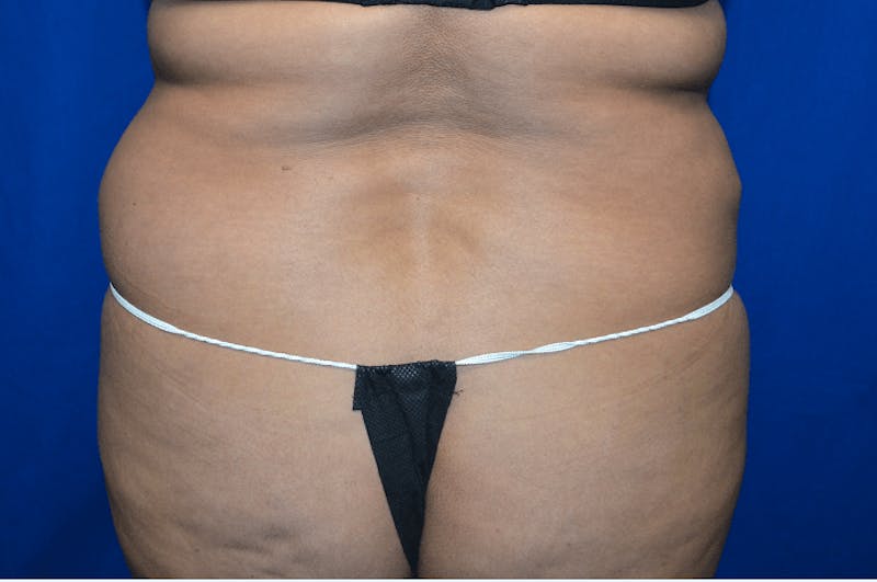 Liposuction Before & After Gallery - Patient 154000 - Image 1