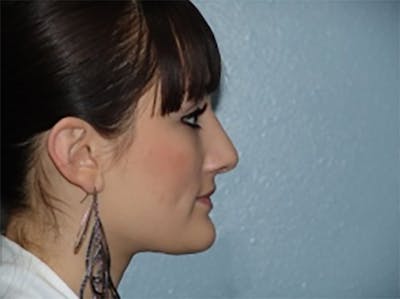 Rhinoplasty Before & After Gallery - Patient 102844 - Image 2