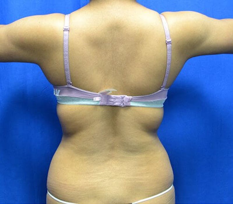Liposuction Before & After Gallery - Patient 416399 - Image 1