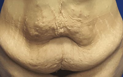 Tummy Tuck Before & After Gallery - Patient 271047 - Image 1