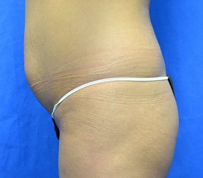 Liposuction Before & After Gallery - Patient 662350 - Image 1