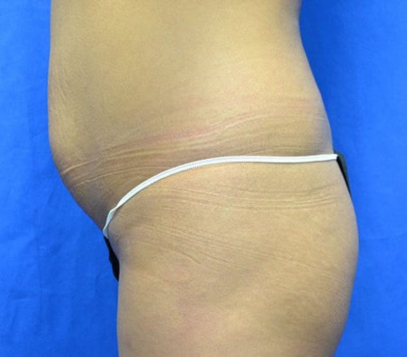 Liposuction Before & After Gallery - Patient 662350 - Image 1