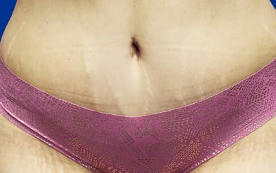 Tummy Tuck Before & After Gallery - Patient 271047 - Image 2
