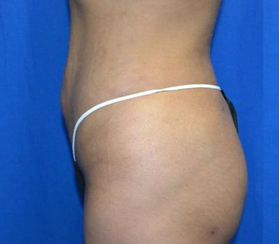 Liposuction Before & After Gallery - Patient 662350 - Image 2