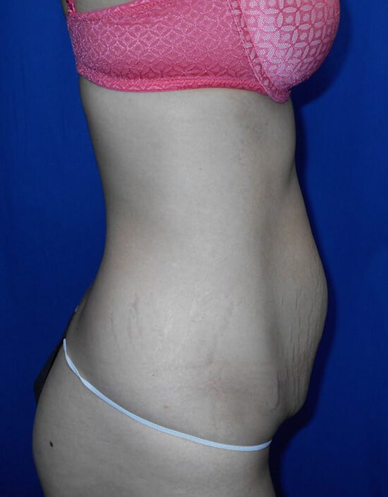 Tummy Tuck Before & After Gallery - Patient 297471 - Image 1