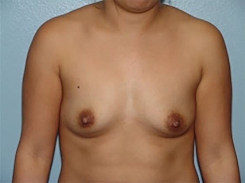 Breast Augmentation Before & After Gallery - Patient 370549 - Image 1