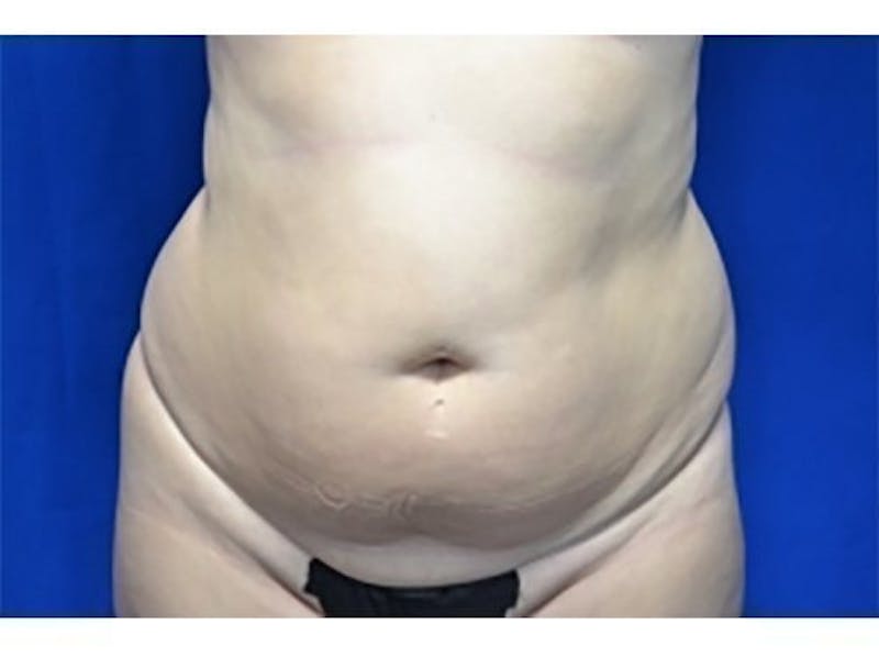 Liposuction Before & After Gallery - Patient 291806 - Image 1