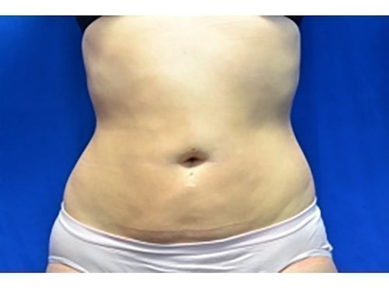 Liposuction Before & After Gallery - Patient 291806 - Image 2