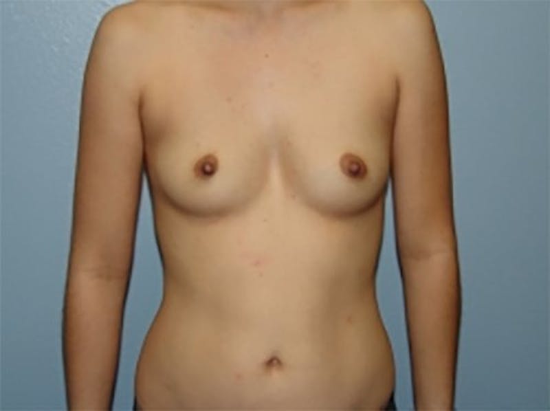 Breast Augmentation Before & After Gallery - Patient 199395 - Image 1