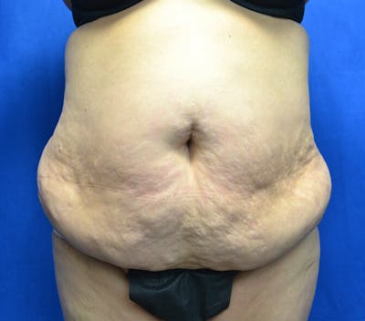 Tummy Tuck Before & After Gallery - Patient 568053 - Image 1