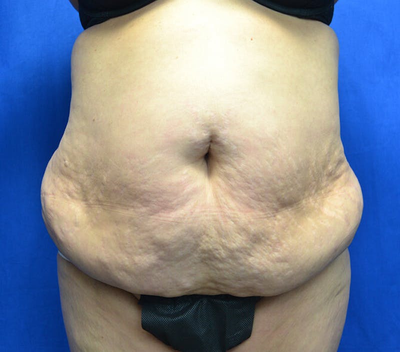 Tummy Tuck Before & After Gallery - Patient 568053 - Image 1