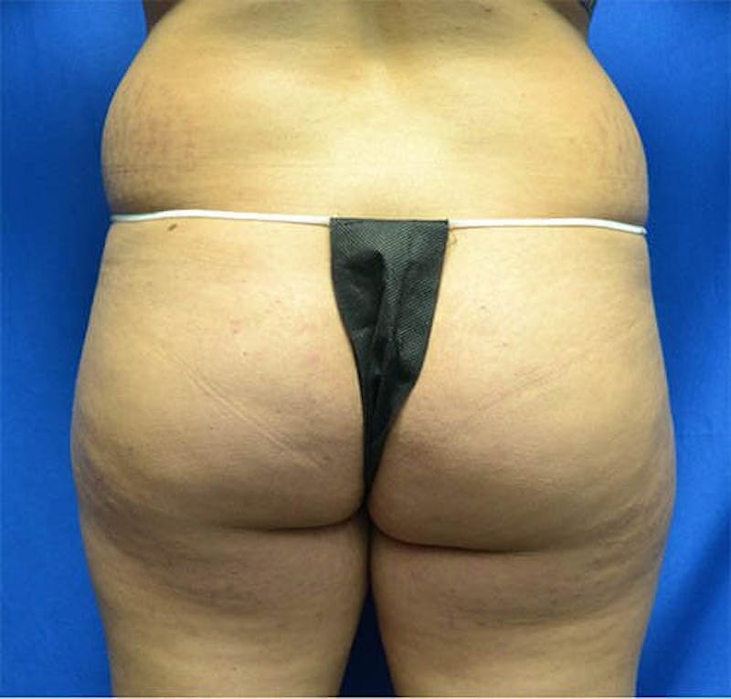 Brazilian Butt Lift Before & After Gallery - Patient 654522 - Image 1