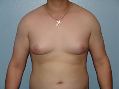 Liposuction Before & After Gallery - Patient 358488 - Image 1