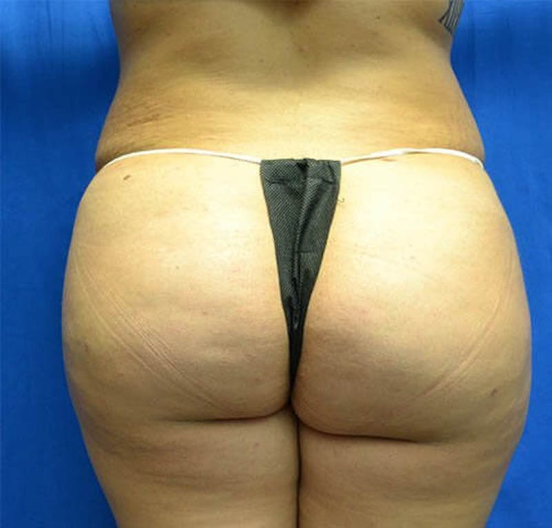 Brazilian Butt Lift Before & After Gallery - Patient 654522 - Image 2
