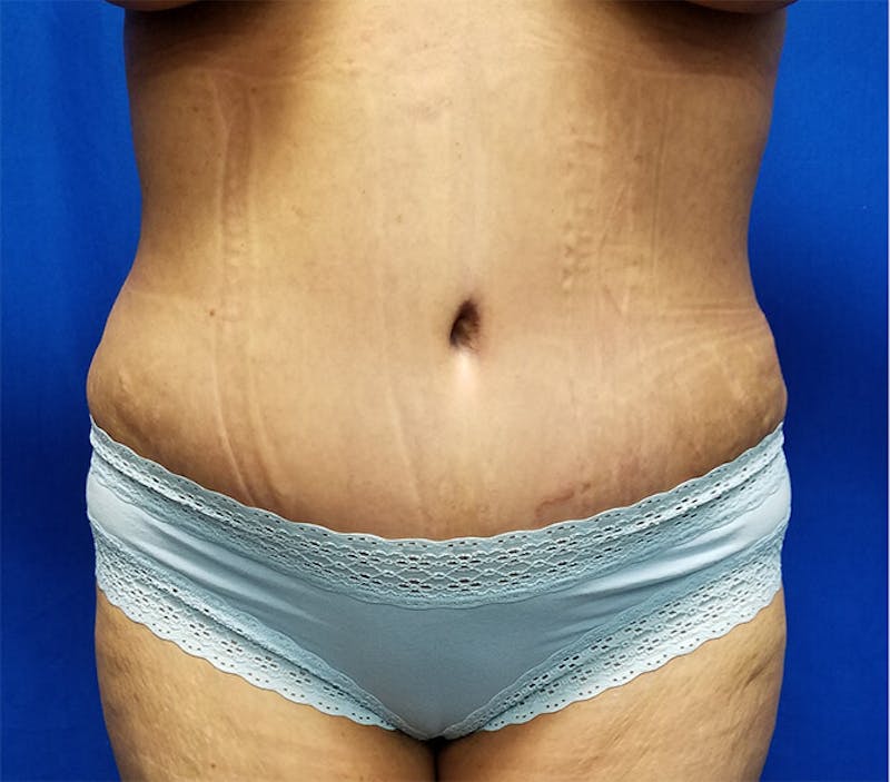 Tummy Tuck Before & After Gallery - Patient 568053 - Image 2