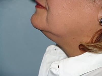 Liposuction Before & After Gallery - Patient 408994 - Image 1