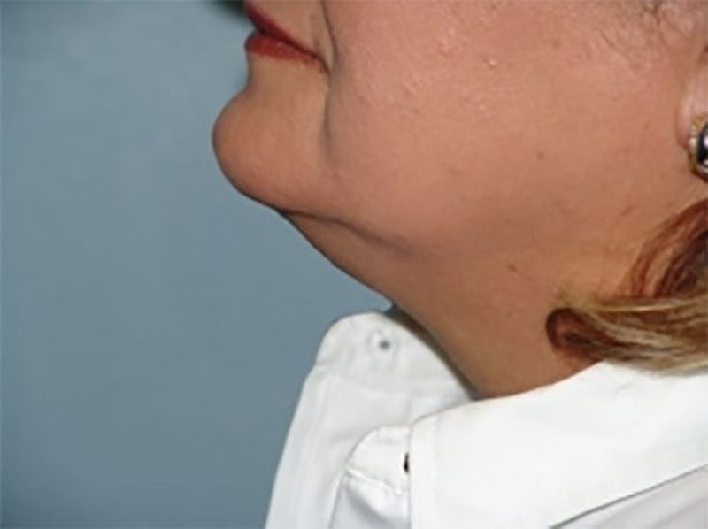 Liposuction Before & After Gallery - Patient 408994 - Image 1