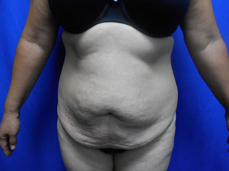 Tummy Tuck Before & After Gallery - Patient 109708 - Image 1