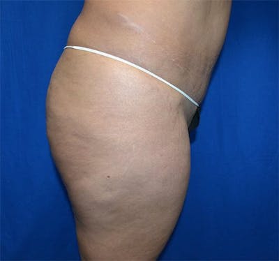 Brazilian Butt Lift Before & After Gallery - Patient 245106 - Image 1