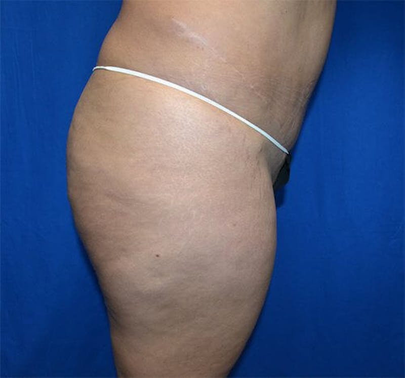 Brazilian Butt Lift Before & After Gallery - Patient 245106 - Image 1