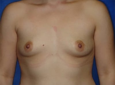 Breast Augmentation Before & After Gallery - Patient 131888 - Image 1