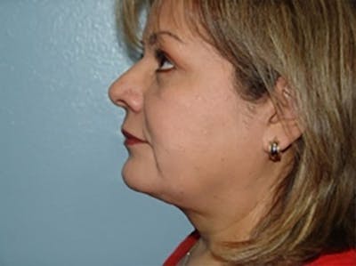 Liposuction Before & After Gallery - Patient 408994 - Image 2