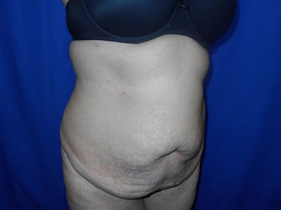 Tummy Tuck Before & After Gallery - Patient 109708 - Image 2