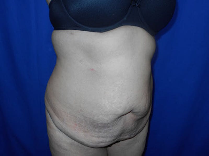 Tummy Tuck Before & After Gallery - Patient 109708 - Image 2