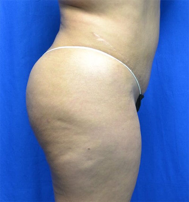 Brazilian Butt Lift Before & After Gallery - Patient 245106 - Image 2