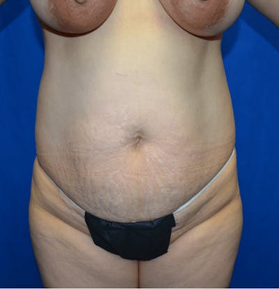 Tummy Tuck Before & After Gallery - Patient 164514 - Image 1