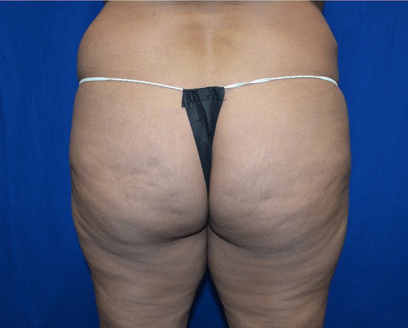 Brazilian Butt Lift Before & After Gallery - Patient 353355 - Image 1