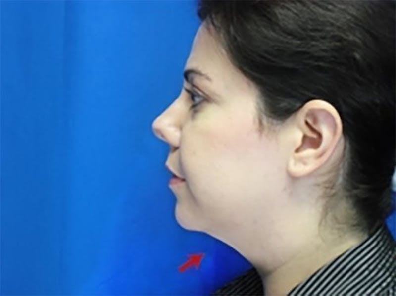 Liposuction Before & After Gallery - Patient 229913 - Image 1