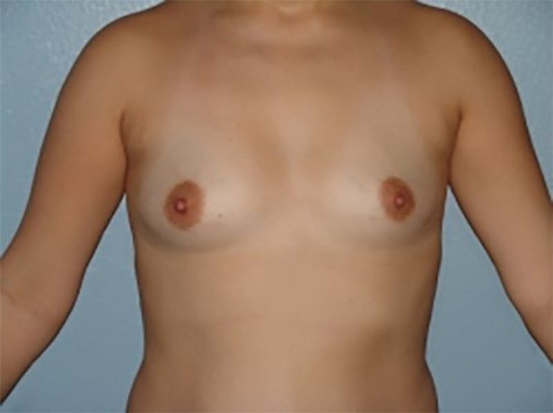 Breast Augmentation Before & After Gallery - Patient 237775 - Image 1