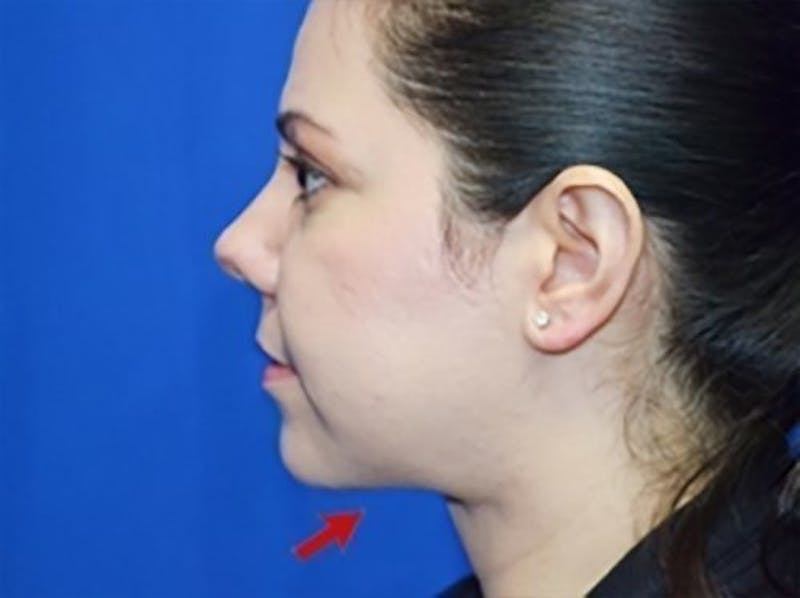 Liposuction Before & After Gallery - Patient 229913 - Image 2
