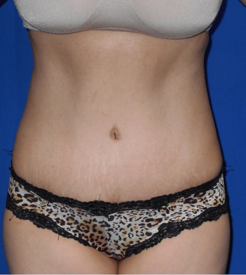Tummy Tuck Before & After Gallery - Patient 164514 - Image 2