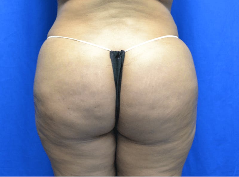 Brazilian Butt Lift Before & After Gallery - Patient 353355 - Image 2