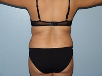 Liposuction Before & After Gallery - Patient 402141 - Image 1