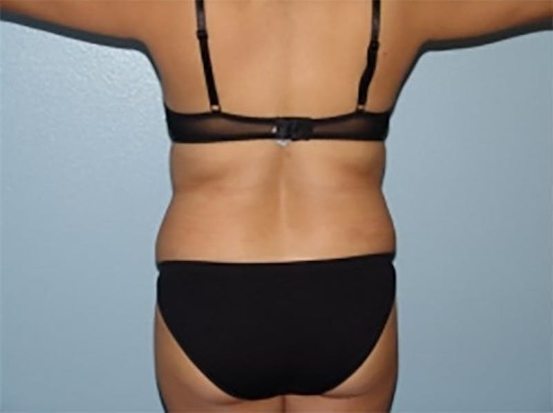 Liposuction Before & After Gallery - Patient 402141 - Image 1