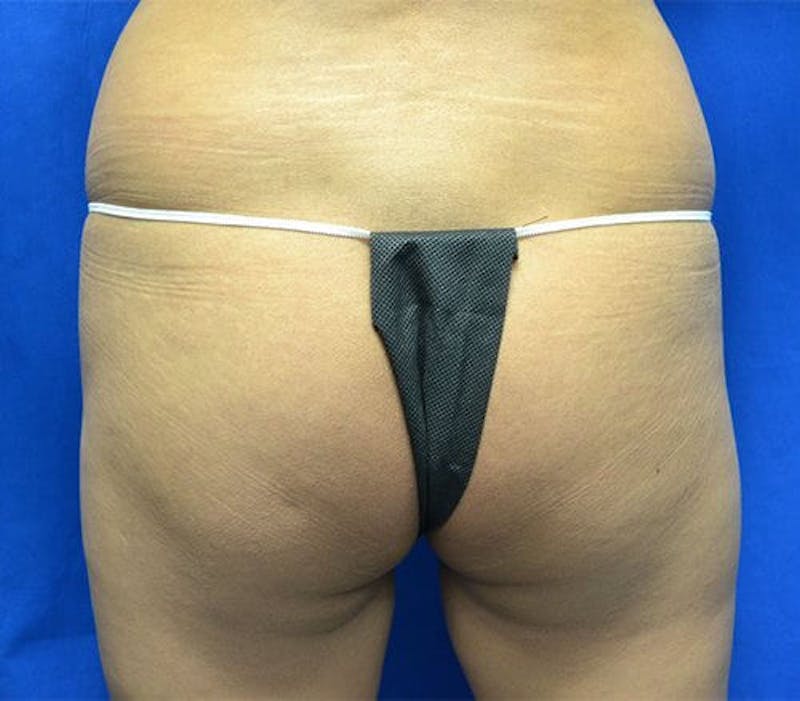 Brazilian Butt Lift Before & After Gallery - Patient 966973 - Image 1
