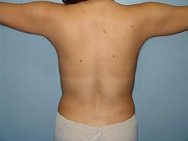 Liposuction Before & After Gallery - Patient 402141 - Image 2