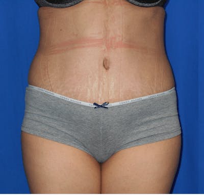 Tummy Tuck Before & After Gallery - Patient 424073 - Image 2