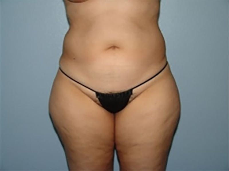 Liposuction Before & After Gallery - Patient 389599 - Image 1