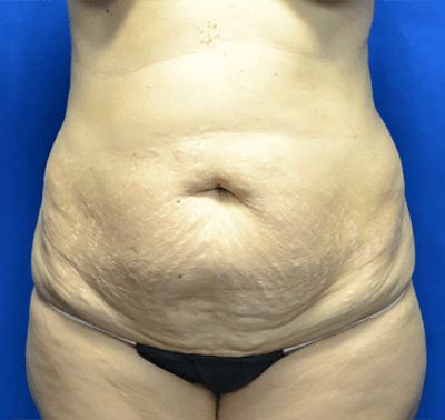 Tummy Tuck Before & After Gallery - Patient 390571 - Image 1