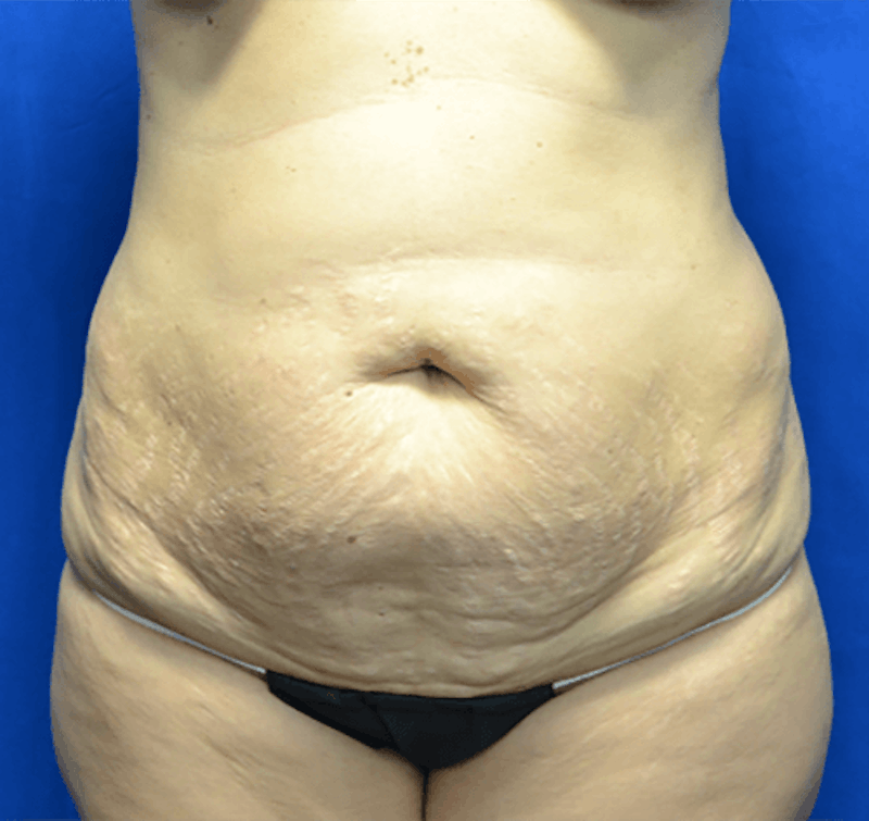 Tummy Tuck Before & After Gallery - Patient 390571 - Image 1