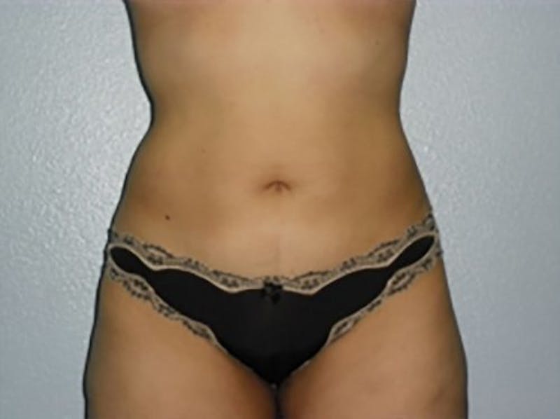 Liposuction Before & After Gallery - Patient 389599 - Image 2