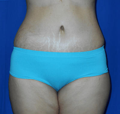 Tummy Tuck Before & After Gallery - Patient 390571 - Image 2