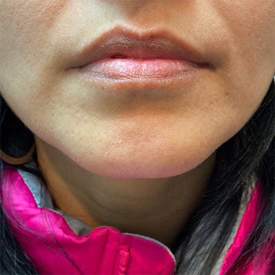 Injectables Before & After Gallery - Patient 173470 - Image 1