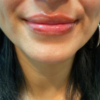 Injectables Before & After Gallery - Patient 173470 - Image 2