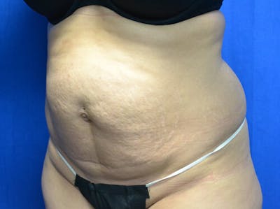 Tummy Tuck Before & After Gallery - Patient 289675 - Image 1